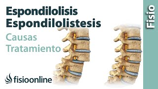 Espondilolisis y espondilolistesis  Qué es causas síntomas y tratamiento [upl. by Odele]