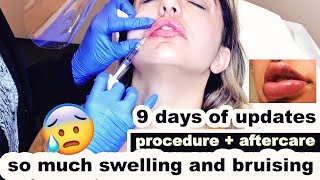 LIP FILLERS  First time tips for faster healing [upl. by Htinek]