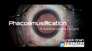 Phacoemulsification Procedure Explained  Ultramodern Cataract Surgery [upl. by Adle]