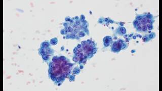 Mesothelioma cytology [upl. by Labina]