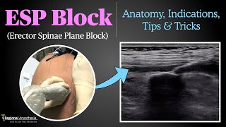 Erector Spinae Plane ESP Block [upl. by Bittencourt933]