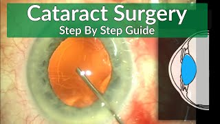 Cataract Surgery Teaching  A Beginners Guide [upl. by Akeihsal]