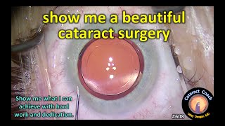 show me a beautiful cataract surgery [upl. by Glorianna526]