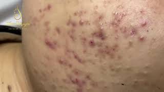 Blackheads removal 324  Loan Nguyen [upl. by Ozmo]