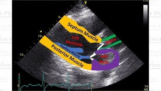 Hypertrophic Cardiomyopathy Parasternal Long Axis Echocardiogram View [upl. by Notsla]