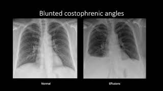 Pleural Effusions [upl. by Tattan]