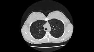 SelfPercussion therapy for chest coughs [upl. by Geiger]