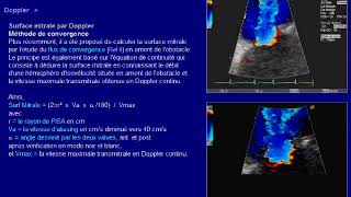 rétrécissement mitrale [upl. by Eralcyram]