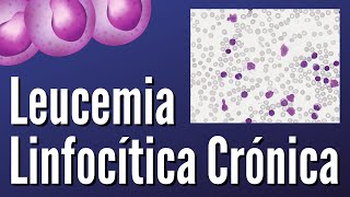 Leucemia Linfocítica Crónica [upl. by Kinson980]