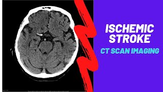 Stroke Diagnosis and Treatment  Acute and Long Term Treatment of Ischemic and Hemorrhagic Stroke [upl. by Ajnos790]