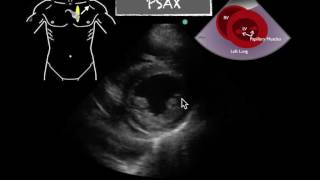 POCUS Cardiac PSAX Severely Reduced EF [upl. by Balcer835]