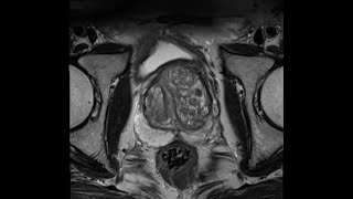 What PSA is and why its important explained by urologist [upl. by Suiramed]