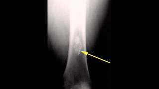 Enchondroma Distal Femur [upl. by Craggie]