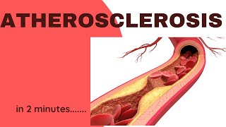 What is Atherosclerosis  Lecturio [upl. by Ylime]