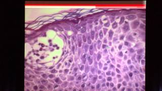 Dermatopathology Pearls Inflammatory Dermatoses [upl. by Alexa]