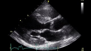 PVC Echo Parasternal Long Axis View  Aortic Stenosis [upl. by Teodor25]