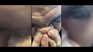 DIY Blackhead Removal Goes Viral [upl. by Alleuqcaj341]