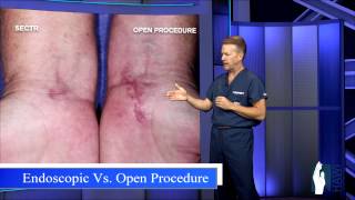 Carpal Tunnel Release  Open Procedure vs Endoscopic [upl. by Kcirddec]