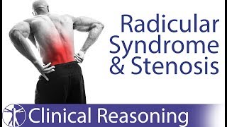 Lumbar Radicular Syndrome vs Intermittent Neurogenic ClaudicationStenosis [upl. by Aiken2]