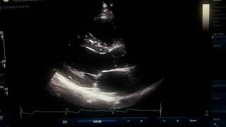 2D Measuring in PLAX amp PSAX [upl. by Dian]