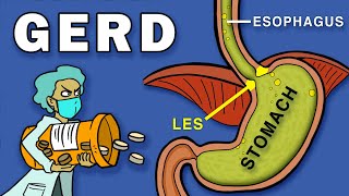 Gastroesophageal Reflux Disease GERD [upl. by Ulita]