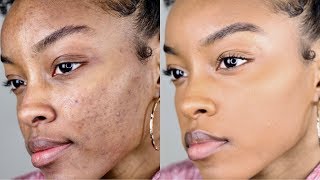 How to cover acnedark spots WITHOUT a lot of makeup  Slim Reshae [upl. by Davies]