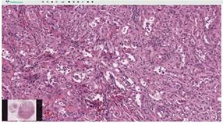 Adenomatoid Tumor  Histopathology [upl. by Mohl244]