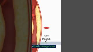 Understanding Ethyrosclerosis A Detailed Look at Artery Plaque Formation [upl. by Airotkiv]