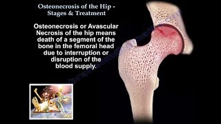 Osteonecrosis Of The Hip Stages amp Treatment  Everything You Need To Know  Dr Nabil [upl. by Yelrebma]