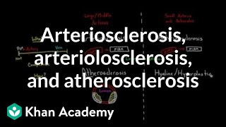 Atherosclerosis Treatment Options [upl. by Corey]