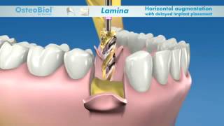 OsteoBiol® Lamina [upl. by Alie55]