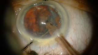 Cataract operatie [upl. by Farrington]