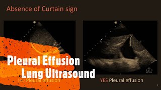 Pleural Effusion Lung Ultrasound Perioperative amp Critical Care POCUS [upl. by Llatsyrk870]