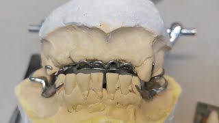 Como Enfilar Dientes En Estructuras De Cromo Cobalto [upl. by Lepper]