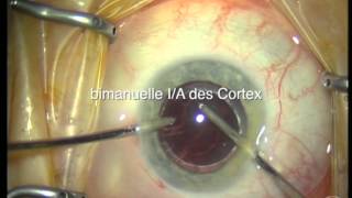 Femto Laser assistierte CataractOP mit Multifokallinse [upl. by Mears]