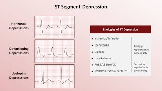 Intro to EKG Interpretation  QRST Changes [upl. by Afesoj]