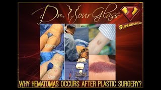 Hematomas after plastic surgery Bleeding complications [upl. by Ahsiemat]