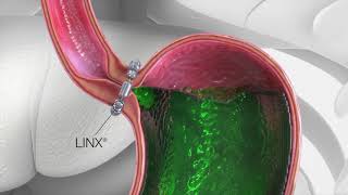 LINX Reflux Surgery Animation [upl. by Eceeryt961]