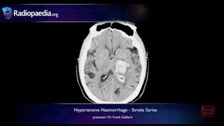 Stroke CVA Cerebrovascular Accident Hemorrhagic Ischemic NCLEX RN amp LPN NURSING [upl. by Ulysses]