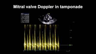 Echocardiography Essentials Detecting pericardial effusions [upl. by Tallia]