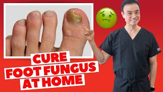 6 Effective HOME REMEDIES To CURE Toenail FUNGUS  Holistic Toenail Fungus Cures Part 2  Dr Kim [upl. by Ahsan]