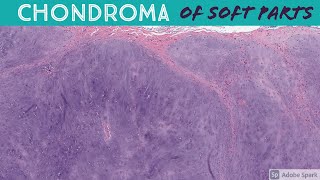 Chondrosarcoma vs Enchondroma Bone Pathology with Dr Andrew Rosenberg [upl. by Adnuhser]