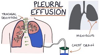 Understanding Pleural Effusions [upl. by Pride531]