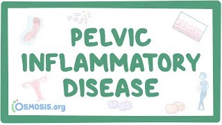 Episode 9  Incidence Causes and Treatment of Pelvic Congestion Syndromes [upl. by Northrup]