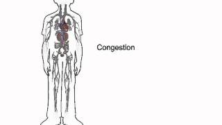 How heart failure causes fluid accumulation  wwwheartfailuremattersorg [upl. by Utas]