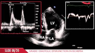 Acute Myocardial Infarction [upl. by Aruol]