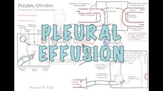 Pleural Effusion DETAILED  pathophysiology signs and symptoms treatment [upl. by Slavin]