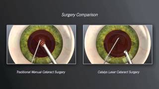 Catalys Laser Cataract Surgery vs Traditional Manual Cataract Surgery  Animation [upl. by Adiaros]