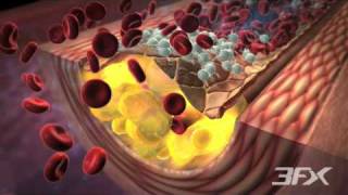 DiabetesRelated Atherosclerosis [upl. by Acinad]