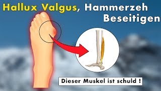 3 Übungen gegen Hallux Valgus Hammerzeh Ballenzeh  Die WAHRE Ursache amp Lösung [upl. by Goren21]